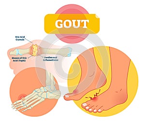 Gout vector illustration. Swollen and inflamed joint labeled scheme.