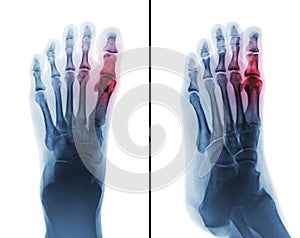 Gouty arthritis . film x-ray of human foot and arthritis at first metatarsophalangeal Joint .