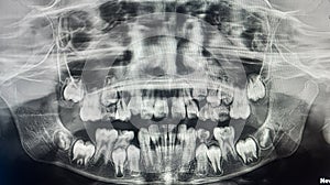 Gowing tooth of 11 years old indian boy