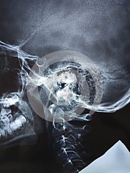 Adenoid hypertrophy Grade III in Xray Nasopharynx