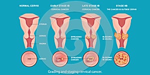 Grading and staging cervical cancer photo