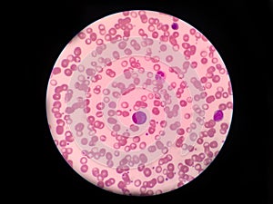 Plasmocyte on red blood cell count