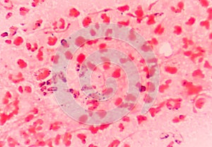 Gram negative diplococci intracellular