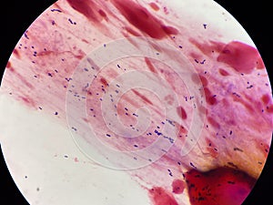 Gram positive bacilli in sputum