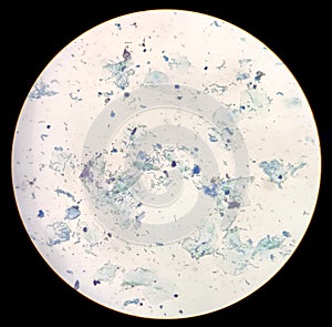 Gram stain of Arcanobacterium haemolyticum colony showing irregularly shaped gram-positive rods recovered from blood culture.