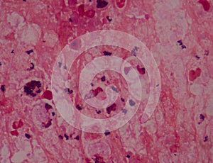 Gram stain showing blue cells gram positive in single,in pair,in cluster intracellular on red white blood cells background.Pus sp