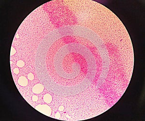 Gram staining , is a method of differentiating bacterial species. gram negative coccus