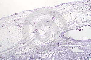 Granulomatous inflammation, light micrograph