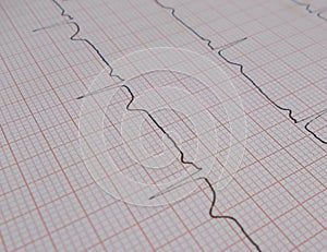 Electrocardiogram