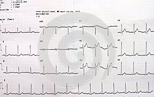 Graph showing the results of the electrocardiogram (EKG) test on recording paper
