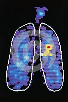 Graphic Image Showing Disease In Human Lung