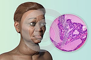 Grave's disease in a woman, 3D illustration and light micrograph of toxic goiter