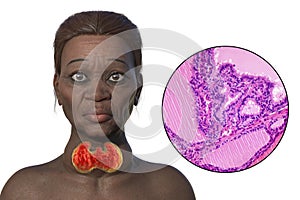 Grave's disease in a woman, 3D illustration and light micrograph of toxic goiter