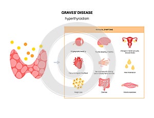 Graves desease symptoms