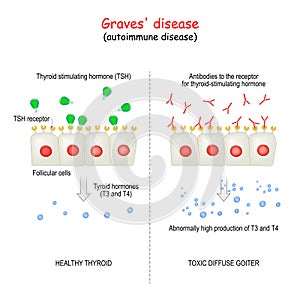 Graves` disease. autoimmune disorder photo