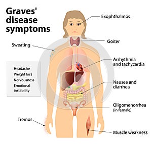 Graves' disease or Basedow disease. Symptoms and signs photo