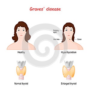 Graves disease. toxic diffuse goiter photo
