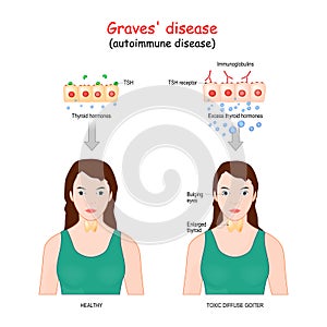 Graves` disease. toxic diffuse goiter is an autoimmune disease that affects the thyroid