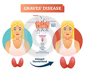 Graves disease vector illustration. Labeled diagnosis symptoms diagram photo