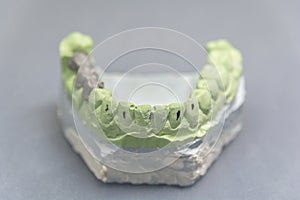 Green dental tooth implant plaster pattern with metal bridge on table