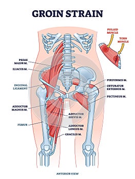 Groin strain trauma and pulled or torn muscle injury anatomy outline diagram photo