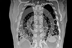 Chest CT Scan of Novel Coronavirus COVID-19 photo