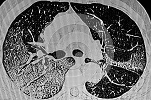 Chest CT Scan of Novel Coronavirus COVID-19 photo