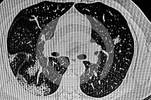 Chest CT Scan of Novel Coronavirus COVID-19 photo