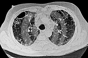 Chest CT Scan of Novel Coronavirus COVID-19 and right upper lobe cavitie. photo