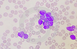 Group of blast cells in leukemia background