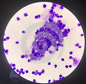 Group of inflammation cells ascitic fluid sample