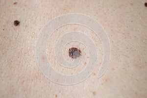 A group of melanomas on back of man