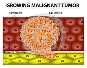 Growing malignant tumor