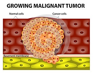 Growing malignant tumor photo