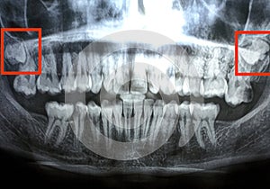 Growing teeth visdom teeth lack of bud