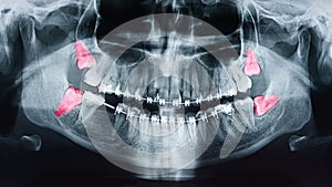 Growing Wisdom Teeth Pain On X-Ray