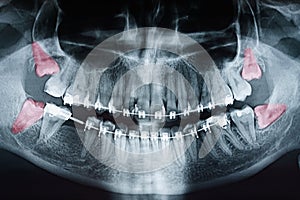 Growing Wisdom Teeth Pain On X-Ray photo