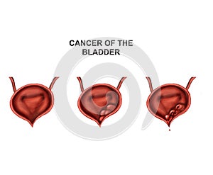 growth of cancer in the bladder
