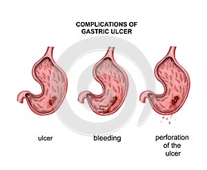 Growth of cancer in the bladder