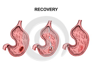 Growth of cancer in the bladder photo