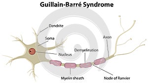 Guillain Barre Disease