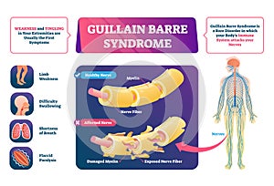 Guillain Barre syndrome vector illustration. Labeled muscle disease scheme.