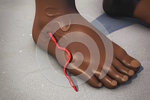 Guinea worm disease, dracunculiasis