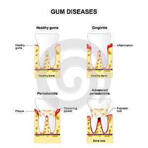 Gum disease