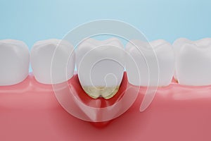 Gum disease, Gingival Recession or inflammation photo