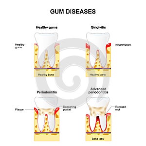 Gum disease photo