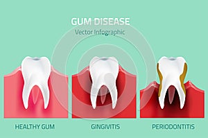 Goma enfermedad progreso. dientes 