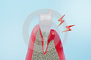 Gum inflammation disease or gingivitis photo