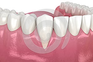 Gum Recession. 3D illustration of Dental problem