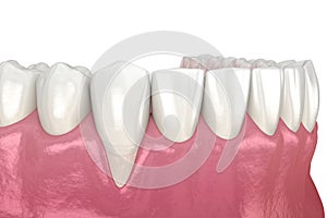 Gum Recession. 3D illustration of Dental problem